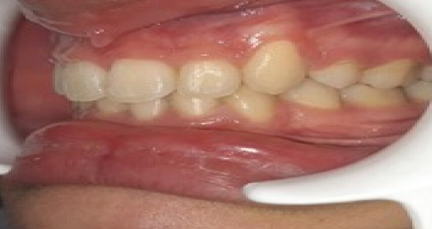 Après traitement d'orthodontie – cas 9, vue de gauche