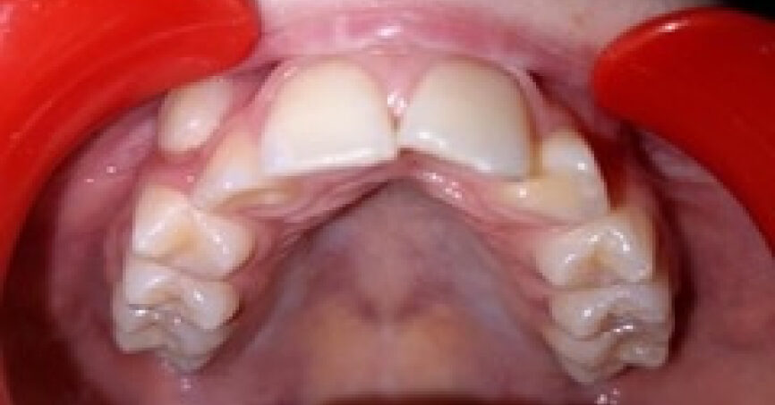 Avant traitement d'orthodontie – cas 10, vue du haut