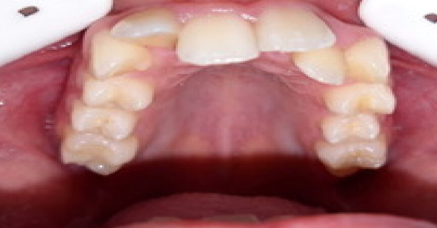 Avant traitement d'orthodontie – cas 9, vue du haut