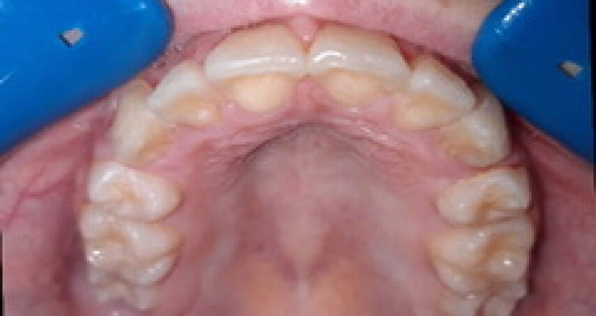 Après traitement d'orthodontie – cas 10, vue du haut