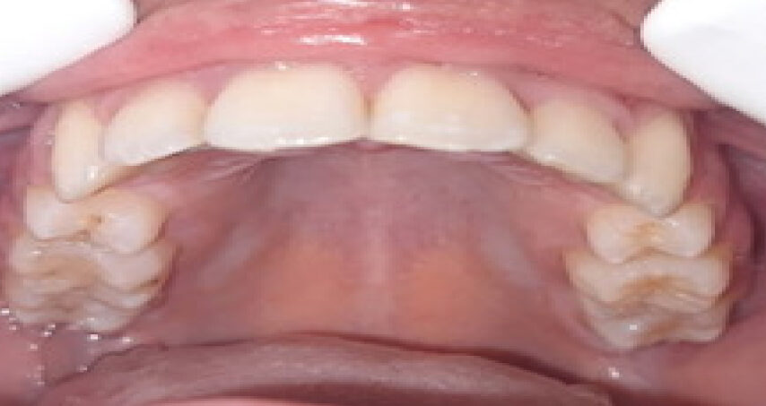 Après traitement d'orthodontie – cas 9, vue du haut